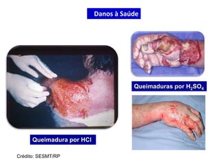 Queimadura por HCl
Queimaduras por H2SO4
Crédito: SESMT/RP
Danos à Saúde
 