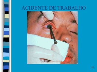 22
ACIDENTE DE TRABALHO
 
