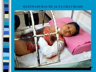 Objetivo Segurança 2016 48
QUEIMADURAS DE ALTA GRAVIDADE
 