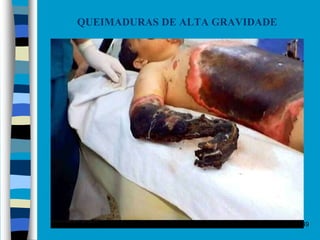 Objetivo Segurança 2016 49
QUEIMADURAS DE ALTA GRAVIDADE
 