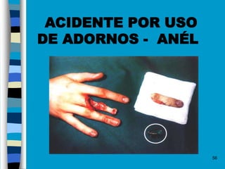56
ACIDENTE POR USO
DE ADORNOS - ANÉL
 
