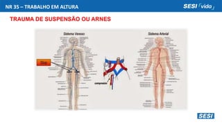 NR 35 – TRABALHO EM ALTURA
TRAUMA DE SUSPENSÃO OU ARNES
 