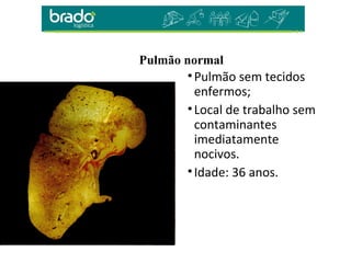 Pulmão normal
•Pulmão sem tecidos
enfermos;
•Local de trabalho sem
contaminantes
imediatamente
nocivos.
•Idade: 36 anos.
 