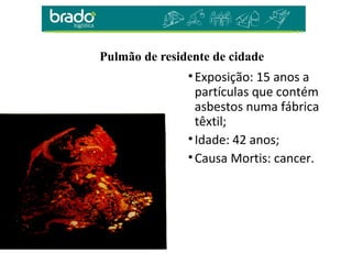 Pulmão de residente de cidade
•Exposição: 15 anos a
partículas que contém
asbestos numa fábrica
têxtil;
•Idade: 42 anos;
•Causa Mortis: cancer.
 