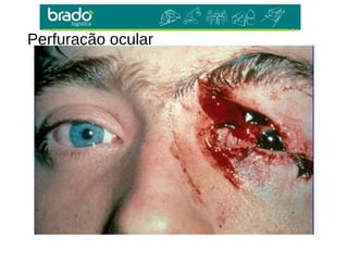 Perfuração ocular
 