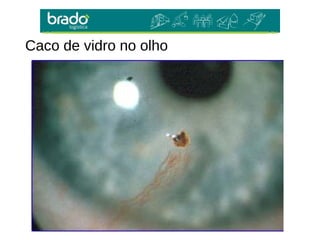 Caco de vidro no olho
 