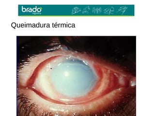 Queimadura térmica
 