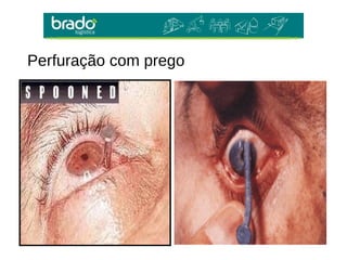 Perfuração com prego
 