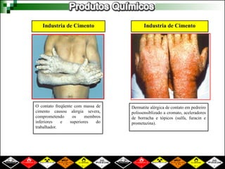 Industria de Cimento Industria de Cimento
O contato freqüente com massa de
cimento causou alergia severa,
comprometendo os membros
inferiores e superiores do
trabalhador.
Dermatite alérgica de contato em pedreiro
polissensiblizado a cromato, aceleradores
de borracha e tópicos (sulfa, furacin e
prometazina).
 