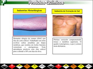 Industrias Metarlúrgicas
Dermatite alérgica de contato (DAC) por
óleo de corte solúvel. Trabalhador em torno
revólver sofreu arranhões por farpas
metálicas, que resultou em lesões linerares
vesiculosas e prurigonosas. Teste
epicutâneos positivos com óleo solúvel
puro e diluído a 50% em óleo de oliva.
Industria de Extração de Sal
Pitíriase versicolor comprometendo
tronco e membros superiores. O
quadro é pruriginoso, o que é comum
nesta dermatose.
 