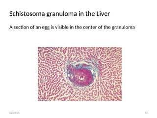 Schistosoma granuloma in the Liver
A section of an egg is visible in the center of the granuloma
15
02/18/25
 