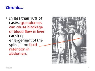 Chronic…
• In less than 10% of
cases, granulomas
can cause blockage
of blood flow in liver
causing
enlargement of the
spleen and fluid
retention in
abdomen.
19
02/18/25
 