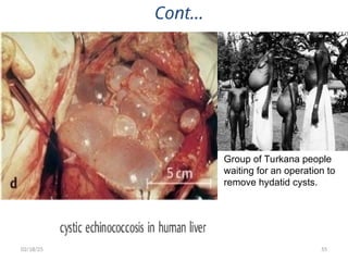 55
Cont…
Group of Turkana people
waiting for an operation to
remove hydatid cysts.
02/18/25
 