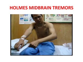 HOLMES MIDBRAIN TREMORS
 