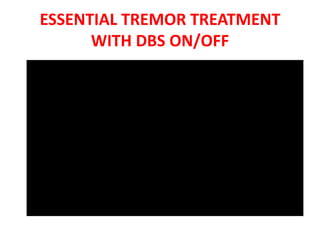 ESSENTIAL TREMOR TREATMENT
WITH DBS ON/OFF
 