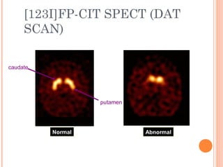 [123I]FP-CIT SPECT (DAT
SCAN)
Normal Abnormal
caudate
putamen
 