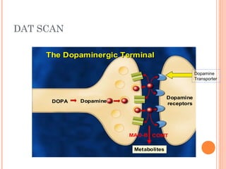 DAT SCAN
Dopamine
receptors
DopamineDOPA
TheThe DopaminergicDopaminergic TerminalTerminal
MAO-B COMT
Metabolites
Dopamine
Transporter
 