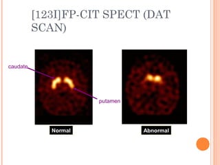 [123I]FP-CIT SPECT (DAT
SCAN)
Normal Abnormal
caudate
putamen
 