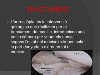 El diagnòstic del metge pot arribar amb una exploració visual i tàctil de la zona danyada. Seguidament es pot veure la lesió mitjançant una Ressonància Magnètica, tot i que la prova mes segura es l'Artroscòpia de genoll.               TRACTAMENTSi no cal intervenir quirúrgicament, podem tractar la lesió amb exercicis programats de potenciació dels músculs de la cama, quàdriceps fonamentalment ja que ens ajudaran a descarregar de feina al genoll.Si la lesió ens produeix immobilitat o constants bloquejos del genoll el pas mes adient es l'Artroscòpia.