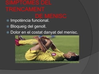 SIMPTOMES DEL TRENCAMENT                   DE MENISCImpotència funcional.Bloqueig del genoll.Dolor en el costat danyat del menisc.