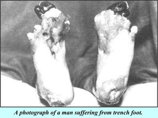 A photograph of a man suffering from trench foot.  