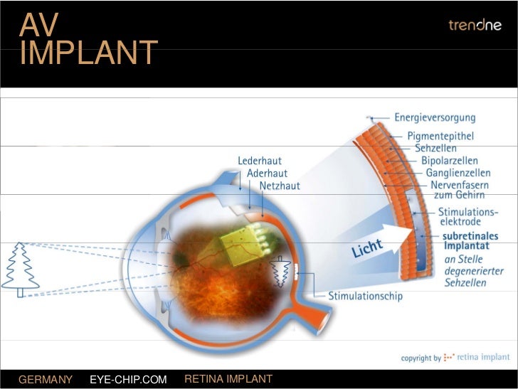 AV IMPLANT GERMANY RETINA