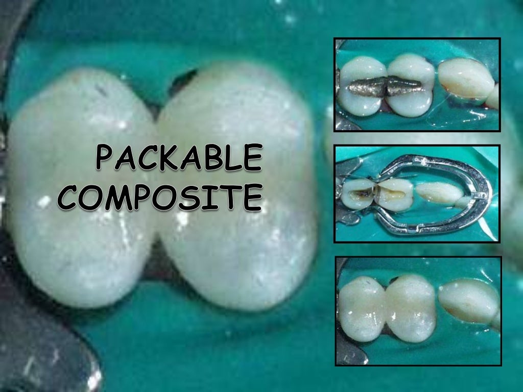 Recent advances in composite dentistry