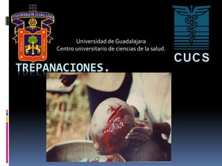 TREPANACIONES.
Universidad de Guadalajara
Centro universitario de ciencias de la salud.
 