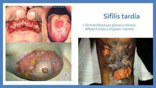 Sífilis tardía
• Se manifiesta por gomas cutáneas
Afecta huesos y órganos internos
 