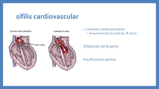 sífilis cardiovascular
• Lesiones cardiovasculares
• Aneurismas de las arterias  aorta
Dilatación de la aorta
Insuficiencia aórtica
 