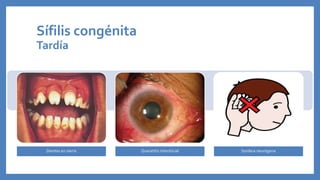 Dientes en sierra Queratitis intersticial Sordera neurógena
Sífilis congénita
Tardía
 