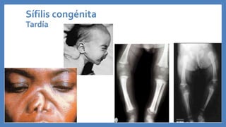 Sífilis congénita
Tardía
 