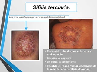 Sífilis terciaria.
Aparecen los sifilomas por un proceso de hipersinsibilidad.
 
