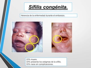 Sífilis congénita.
Herencia de la enfermedad durante el embarazo.
33% muere.
33% presenta los estigmas de la sífilis.
33% nace sin complicaciones.
 