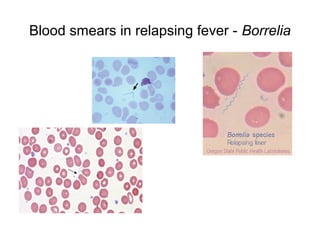 Blood smears in relapsing fever - Borrelia
 