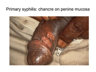 Primary syphilis: chancre on penine mucosa
 