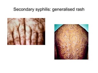 Secondary syphilis: generalised rash
 