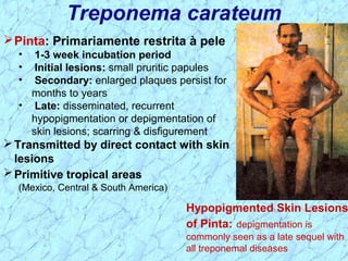 Treponema carateum
Pinta: Primariamente restrita à pele
• 1-3 week incubation period
• Initial lesions: small pruritic papules
• Secondary: enlarged plaques persist for
months to years
• Late: disseminated, recurrent
hypopigmentation or depigmentation of
skin lesions; scarring & disfigurement
Transmitted by direct contact with skin
lesions
Primitive tropical areas
(Mexico, Central & South America)
Hypopigmented Skin Lesions
of Pinta: depigmentation is
commonly seen as a late sequel with
all treponemal diseases
 
