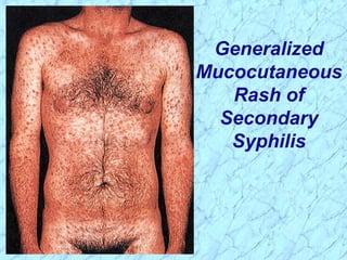 Generalized
Mucocutaneous
Rash of
Secondary
Syphilis
 
