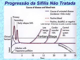 Progressão da Sífilis Não Tratada
Tertiary Stage
Late benign Gomas na pele e partes moles
 