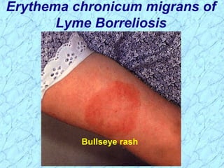 Erythema chronicum migrans of
Lyme Borreliosis
Bullseye rash
 