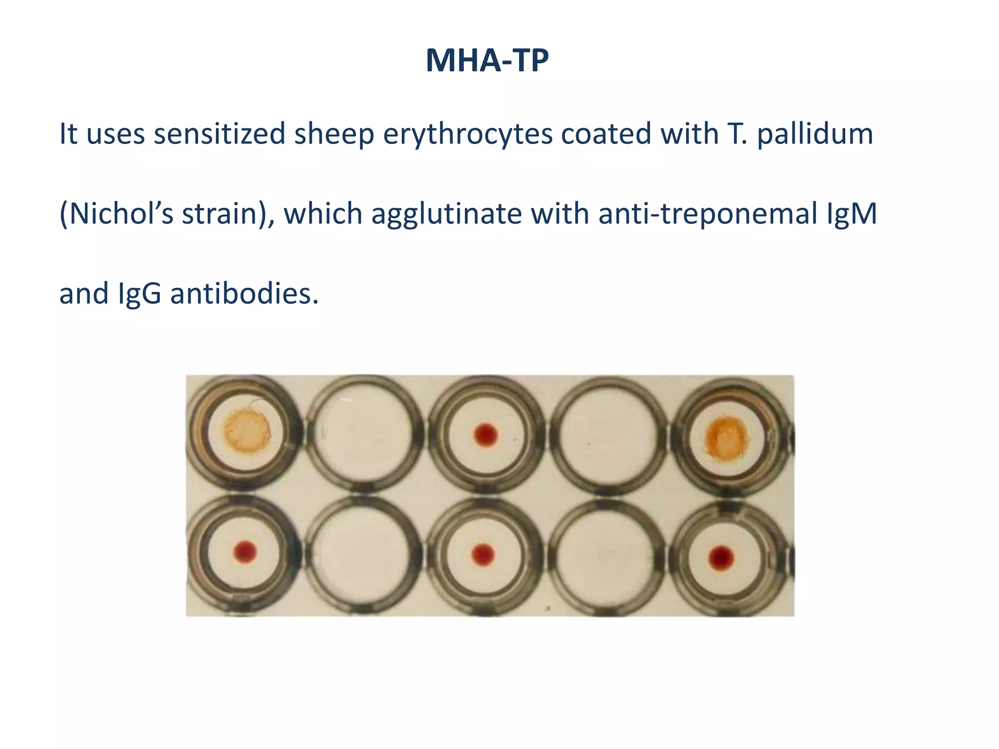 MHA-TP
It uses sensitized sheep erythrocytes coated with T. pallidum
(Nichol’s strain), which agglutinate with anti-treponemal IgM
and IgG antibodies.
 