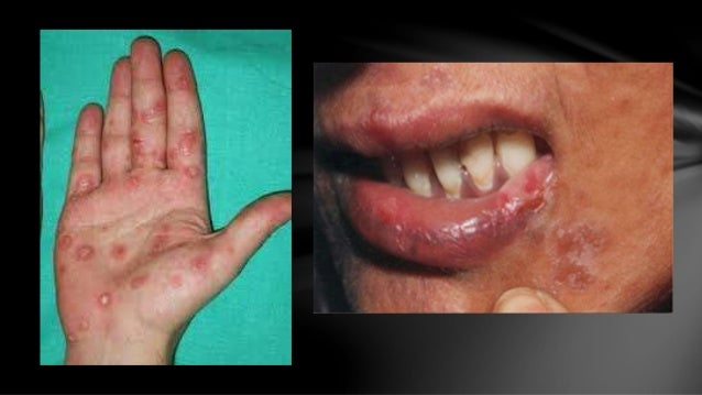 Treponema Rash Treponema pallidum