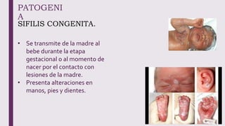 PATOGENI
A
SIFILIS CONGENITA.
• Se transmite de la madre al
bebe durante la etapa
gestacional o al momento de
nacer por el contacto con
lesiones de la madre.
• Presenta alteraciones en
manos, pies y dientes.
 