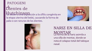 Dientes de
Hutchinson
PATOGENI
A
Se deben a una exposición a la sífilis congénita en
la etapa uterina del bebé, causando la forma de
pala o con ranuras de los dientes.
NARIZ EN SILLA DE
MONTAR.
La forma de la nariz asimila a
una silla de montar, donde se
nota el colapso total del tabique
nasal.
 
