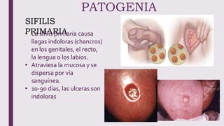 PATOGENIA
• La sífilis primaria causa
llagas indoloras (chancros)
en los genitales, el recto,
la lengua o los labios.
• Atraviesa la mucosa y se
dispersa por vía
sanguínea.
• 10-90 días, las ulceras son
indoloras
SIFILIS
PRIMARIA
 