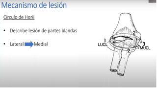 TRATAMIENTO CONSERVADOR
ORTOPEDICO
• Fractura no desplazada y no complicada ,acabalgamiento < 1.5 cm.
• No se recomienda en ningún momento, realizar maniobras de reducción a nivel de clavícula, porque las fracturas de clavícula
usualmente son inestables y no hay forma de brindar soporte externo.
• Ningún vendaje reduce una fractura desplazada El vendaje tipo Velpau y el vendaje en”8” pueden producir lesión dérmica y/o
compresión del paquete neurovascular.
• Se recomienda el uso de,inmovilizador de hombro , o “cabestrillo” con la finalidad de inmovilizar la extremidad del lado en que se
encuentra la fractura de la clavícula, lo que permitirá su consolidación.
• El tiempo de recuperación de las fracturas de clavícula que son manejadas en forma conservadora es en promedio de 90 días.
 