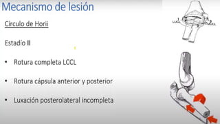 Luxación Acromioclavicular
 
