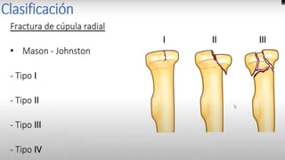 LUXACION GLENOHUMERAL
Introducción
La articulación del hombro es la articulación con más
movilidad, realiza flexión, extensión, abducción,
aducción, rotación lateral y medial
Definición
Pérdida de contacto entre la cabeza humeral
y la cavidad glenoidea de la escápula.
Epidemiología
• Luxación más frecuente del organismo (45
– 60% de todas las luxaciones).
• Esta luxacion representa el 30% de todas
las lesiones agudas de hombro.
• Se presenta en jóvenes con factores de
riesgo(deportistas, hiperlaxos,luxaciones
previas.
• Pulsos distales,función del nervio axilar,
es el mas comúnmente se lesiona, perdida
sensiblidad región deltoidea y perdida de
la función del deltoides, pre y post
reducción.
 