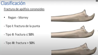 Luxación de hombro (Tracciones) Tracción de kocher
I. Tracción axial con rotación externa del brazo.
II. Aducción del brazo.
III. Rotación interna del brazo.
En este momento se percibe resalte articular que indica la
reducción.
Sólo es aplicable en los casos de luxación anterior.
 